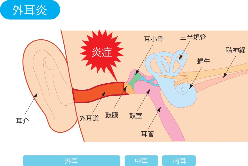 外耳の炎症について解説
