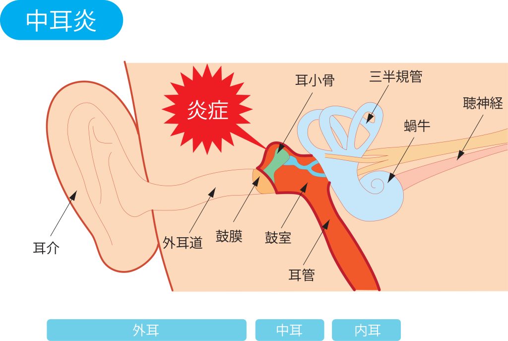 中耳の炎症を解説