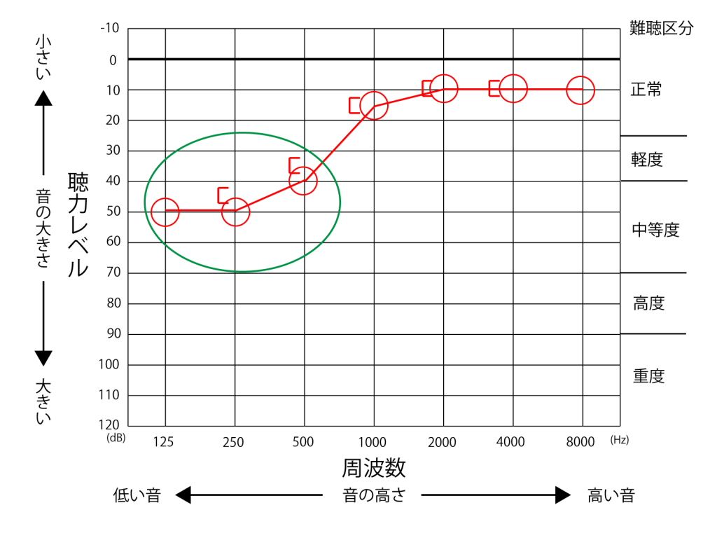 急性低音障害型感音難聴オージオグラム
